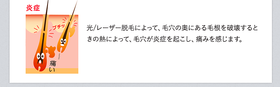 レーザー脱毛によって、毛穴の奥にある毛根を破壊するときの熱によって、毛穴が炎症を起こし痛みを感じます。