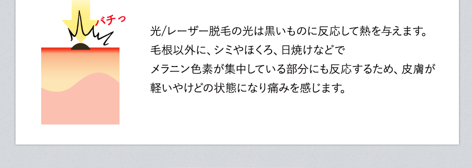 レーザー脱毛の光は黒いもの反応して熱を与えます。毛根以外に、シミやほくろ、日焼けなどでメラニン色素が集中している部分にも反応するため、皮膚が軽いやけどの状態になり痛みを感じます。