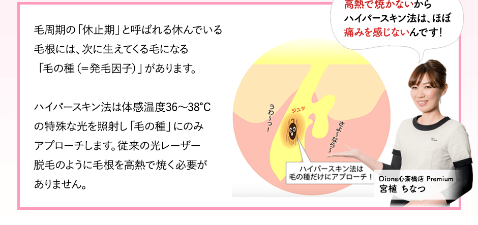 ハイパースキン法は毛の種だけにアプローチ。高熱で焼かないからハイパースキン法はほぼ痛みを感じないんです。ディオーネ心斎橋店宮植ちなつ