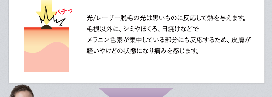 レーザー脱毛の光は黒いもの反応して熱を与えます。毛根以外に、シミやほくろ、日焼けなどでメラニン色素が集中している部分にも反応するため、皮膚が軽いやけどの状態になり痛みを感じます。